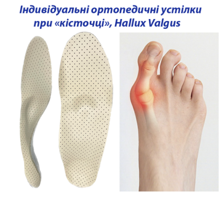 Индивидуальные ортопедические стельки при косточке на ногах, Hallux Valgus